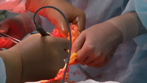 Abdominal liposuction. Partial removal of fat and mucous tissues of the abdomen Stock Footage 83191356