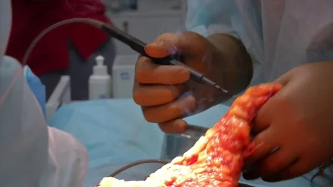 Abdominal liposuction. Partial removal of fat and mucous tissues of the abdomen Stock Footage 83191437