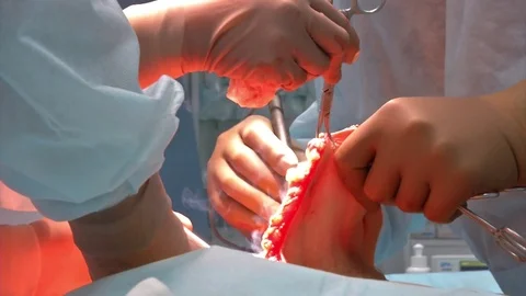 Abdominal liposuction. Partial removal of fat and mucous tissues of the abdomen Stock Footage 83191488