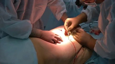 Abdominal liposuction. Partial removal of fat and mucous tissues of the abdomen. Vidéo 83191594