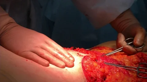 Abdominal liposuction. Partial removal of fat and mucous tissues of the abdomen Stock Footage 83196570