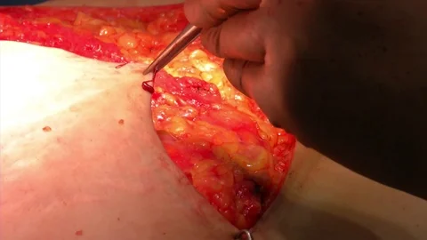 Abdominal liposuction. Partial removal of fat and mucous tissues of the abdomen Stock Footage 83197722