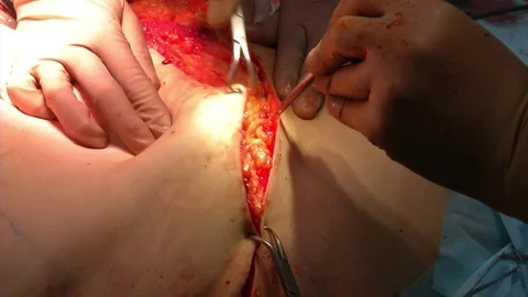 Abdominal liposuction. Partial removal of fat and mucous tissues of the abdomen Stock Footage 83197782