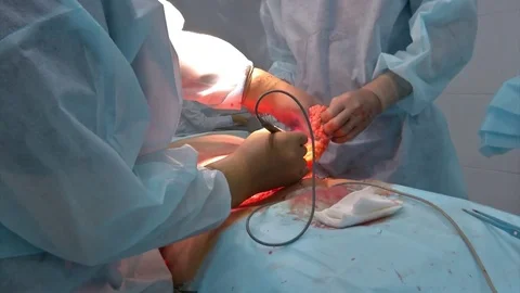 Abdominal liposuction. Partial removal of fat and mucous tissues of the abdomen Stock Footage 83197856