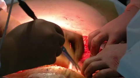 Abdominal liposuction. Partial removal of fat and mucous tissues of the abdomen Stock Footage 83198010