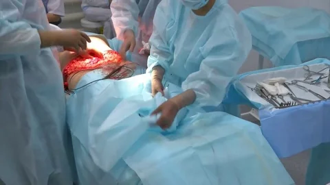 Abdominal liposuction. Partial removal of fat and mucous tissues of the abdomen Stock Footage 83198079