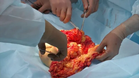 Abdominal liposuction. Partial removal of fat and mucous tissues of the abdomen. Stock Footage 83198243