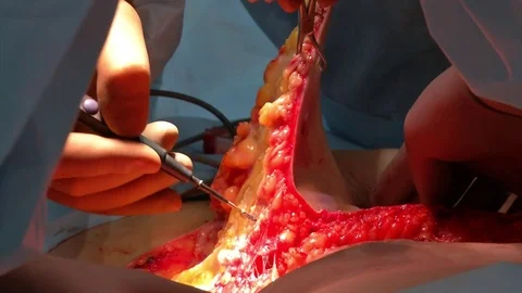 Abdominal liposuction. Partial removal of fat and mucous tissues of the abdomen. Stock Footage 83199112