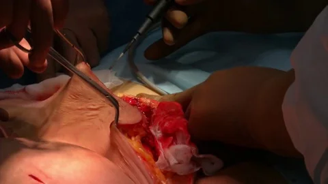 Abdominal liposuction. Partial removal of fat and mucous tissues of the abdomen. Stock Footage 83199233