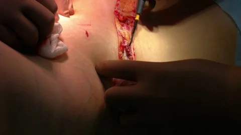 Abdominal liposuction. Partial removal of fat and mucous tissues of the abdomen. Stock Footage 83199744