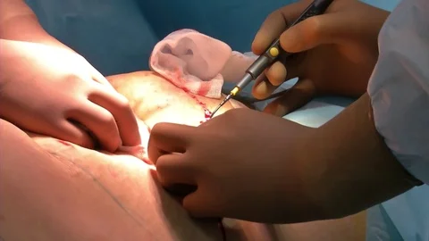 Abdominal liposuction. Partial removal of fat and mucous tissues of the abdomen. Video stock 83199915