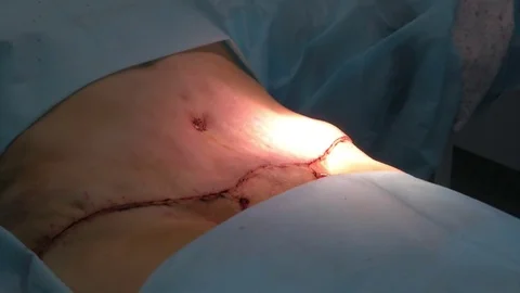 Abdominal liposuction. Stitches on the abdomen after surgery Stock Footage 83189853