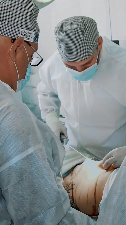 Abdominal liposuction, surgery in actual operating room. surgeon pumps out fat Stock-Footage 318682440