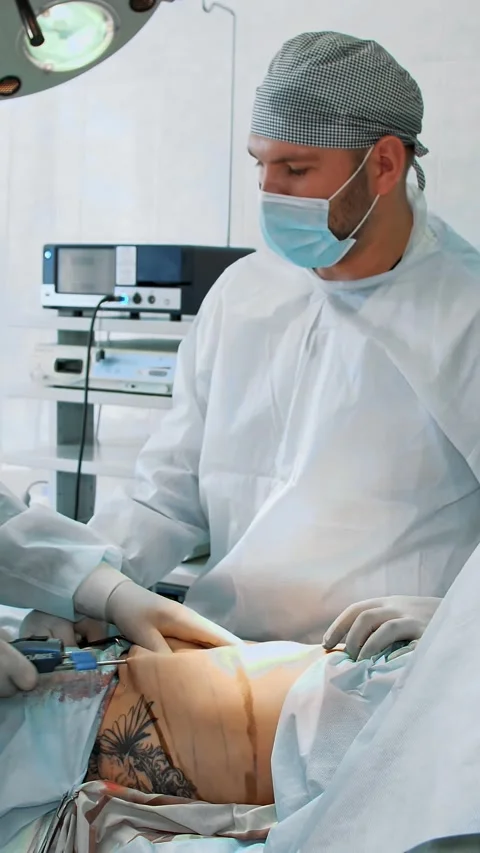 Abdominal liposuction, surgery in actual operating room. surgeon pumps out fat Stock-Footage 318682591