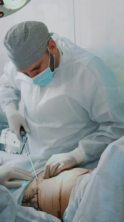 Abdominal liposuction, surgery in actual operating room. surgeon pumps out fat Stock-Footage 318725391