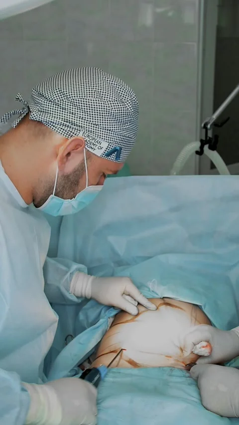 Abdominal liposuction, surgery in actual operating room. surgeon pumps out fat Stock-Footage 318806365