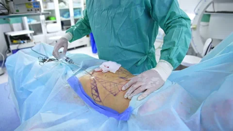 Abdominal liposuction surgery in process. Stock Footage 219976304