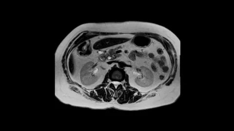Abdominal MRI Scan Sequence Analysis Stock Footage 341776981
