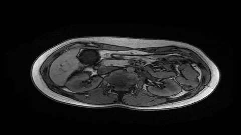 Abdominal MRI Slice Sequence from a Parasitic Liver Cyst Examination Video stock 289736394