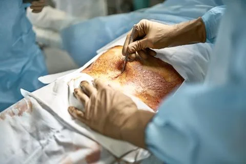Abdominal operation process Foto stock