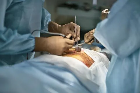 Abdominal operation process Stock-Fotos