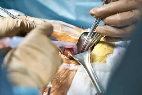 Abdominal operation process Stock-Fotos