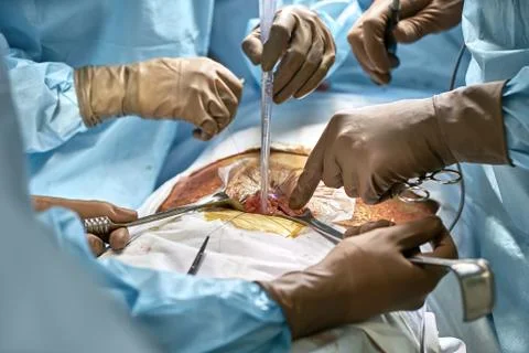Abdominal operation process Stock Photos