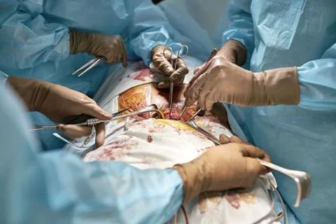 Abdominal operation process 스톡 사진