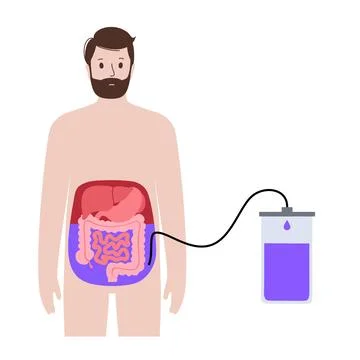 Abdominal paracentesis poster Stock Illustration