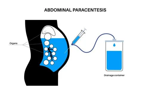 Abdominal paracentesis poster Stock Illustration