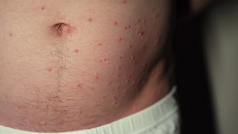 The abdominal region - multiple bumps that are likely attributed to insect Stock Footage 244704924
