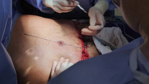 Abdominoplasty. Close-up of the patient on the operating Vídeo Stock 204872582