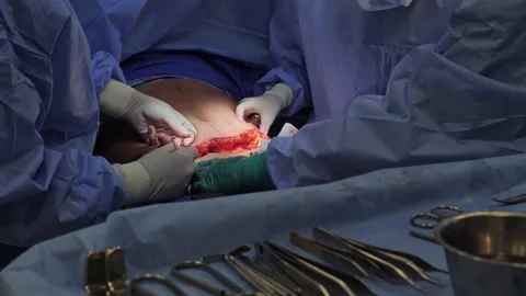 Abdominoplasty. Close-up of the patient on the operating Vídeo Stock 204873048