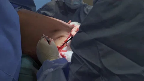 Abdominoplasty. Close-up of the patient on the operating Vídeos de archivo 204873656