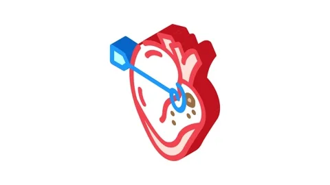 Ablation surgery isometric icon animation Stock Footage 327283164