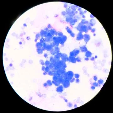 Abnormal cell in plural fluid find with microscope. Stock Photos