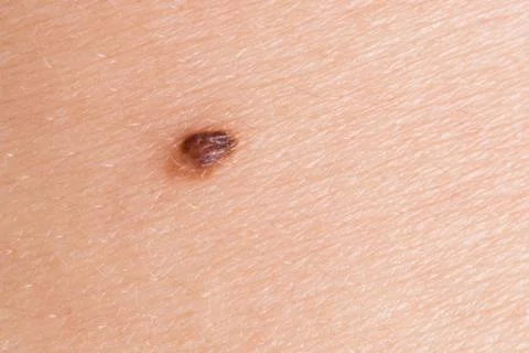 Abnormal mole Foto stock