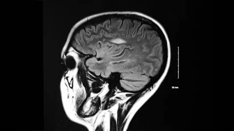 Abnormal mri brain multiple sclerosis lesions sagittal Stock Footage