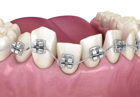 Abnormal teeth position and Clear braces tretament. Medically accurate dental Ilustração Stock