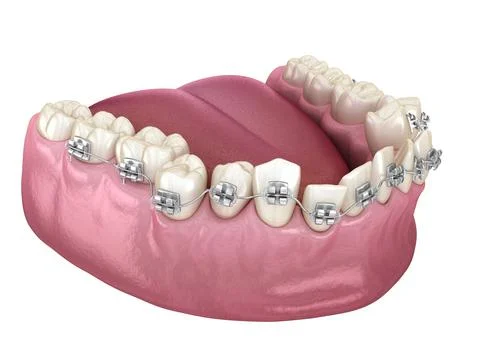 Abnormal teeth position and Clear braces tretament. Medically accurate dental Illustrazione stock