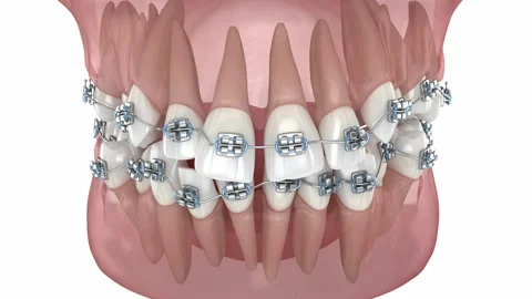 Abnormal teeth position and correction with metal braces tretament. Stock-Footage 205078875