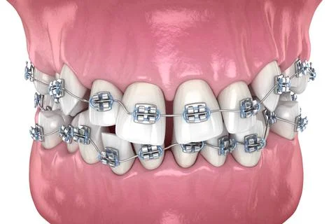 Abnormal teeth position and correction with metal braces tretament. Illustrazione stock