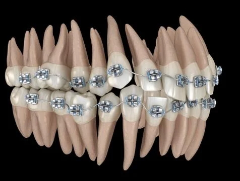 Abnormal teeth position and metal braces tretament. Medically accurate dental Stockillustratie
