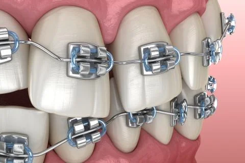 Abnormal teeth position and metal braces tretament. Medically accurate dental Stock Illustration