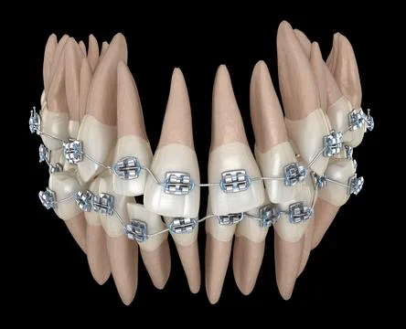 Abnormal teeth position and metal braces tretament. Medically accurate dental Illustrazione stock