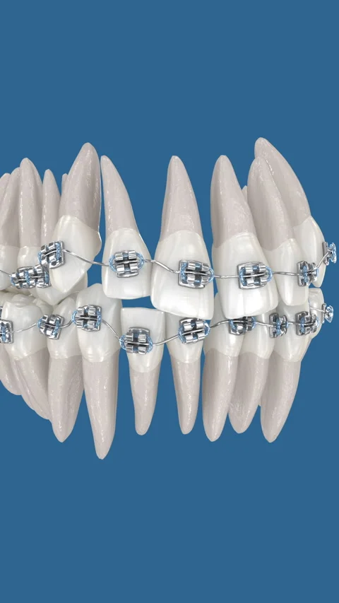 Abnormal teeth position correction with metal braces tretament Stock-Footage 314452137