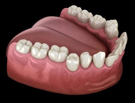 Abnormal teeth position, orthodontic concept. Medically accurate tooth 3D ill Stock Illustration