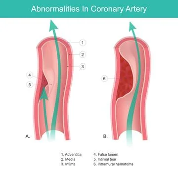 Abnormalities In Coronary Artery. Stock Illustration