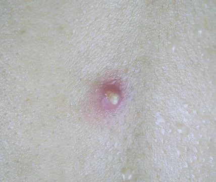 Abscess at back Stock Photos