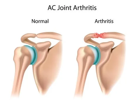 AC joint arthritis Stock Illustration